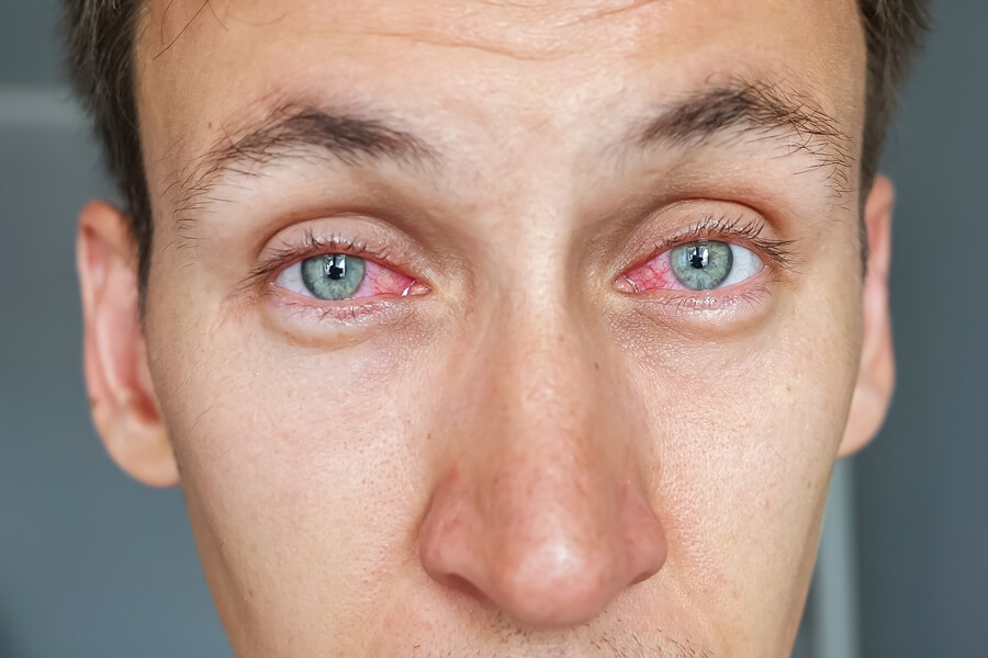 High Eyes: Understanding and Managing Stoned Eyes
